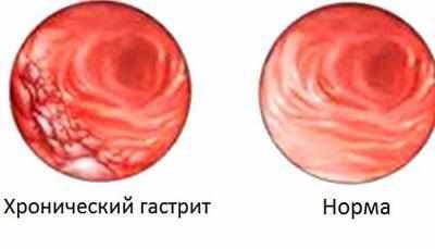 Слизистая при гастрите