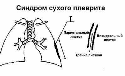 Сухой плеврит