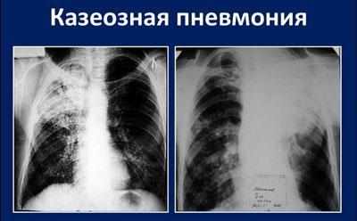 Казеозная пневмония