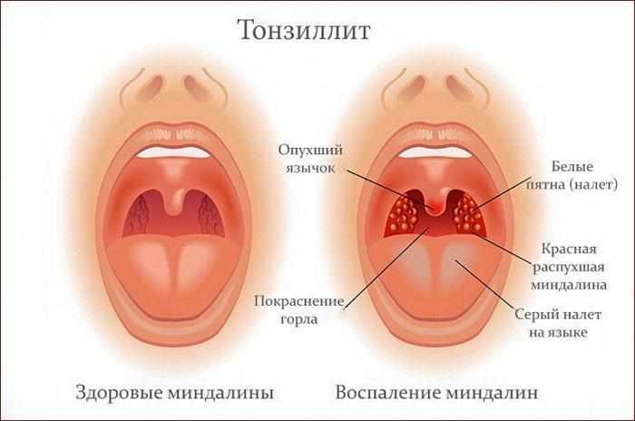 Симптомы тонзиллита