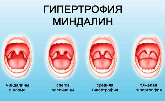 Степени гипертрофии миндалин