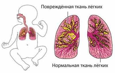 Пневмония у новорожденного