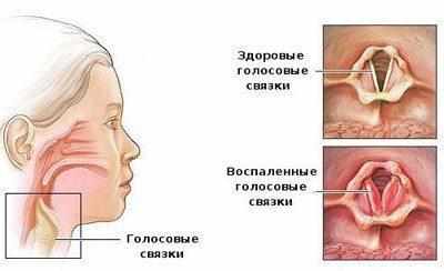 Проявление ларингита