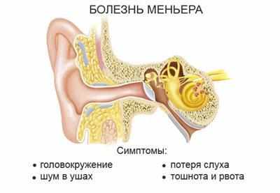 Болезнь меньера