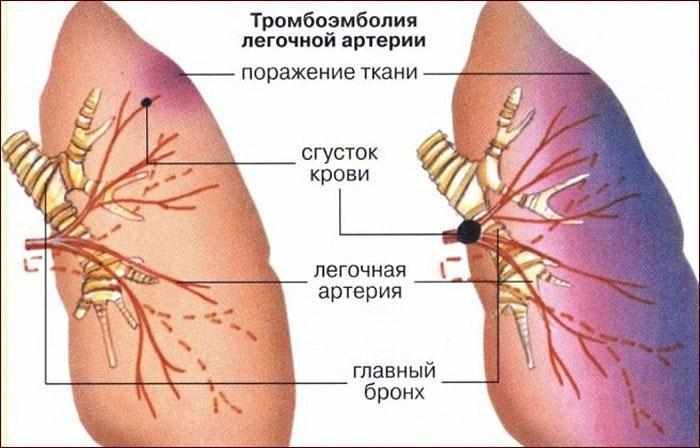 лёгочная эмболия