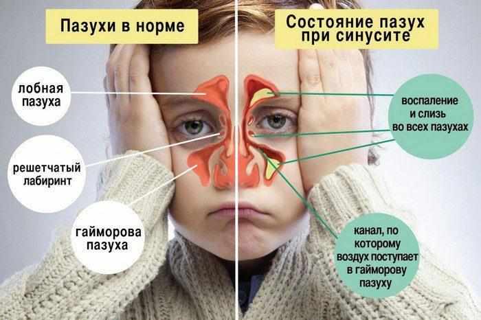 Локализация синусита