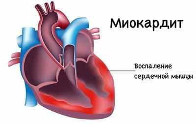 Проявление миокардита