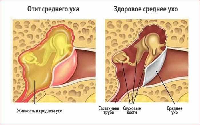 Отит среднего уха