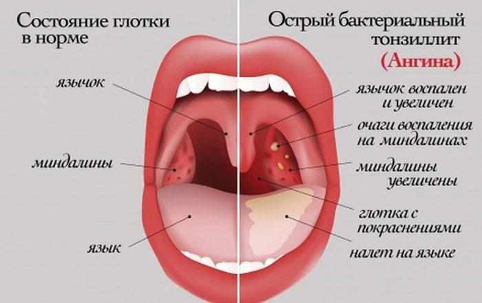 Горло при ангине