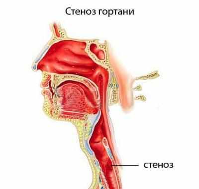 Острый стеноз 