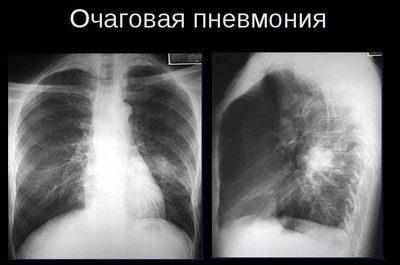 Очаговая пневмония на снимке