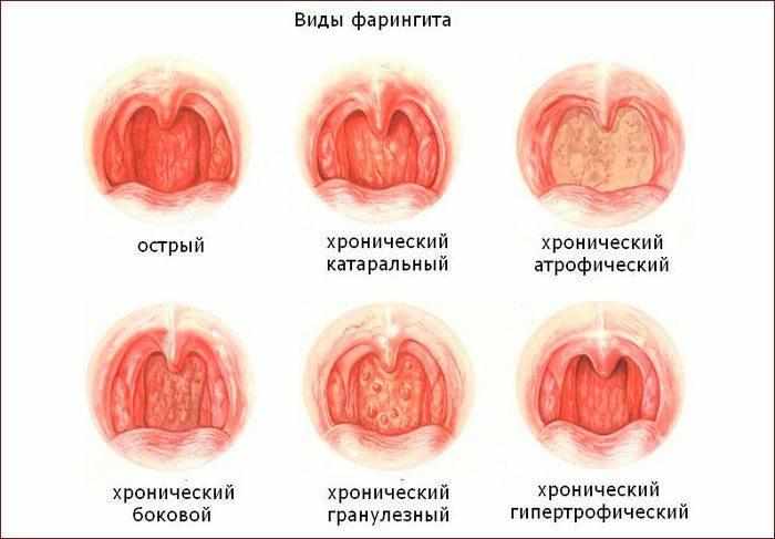 Виды фарингита