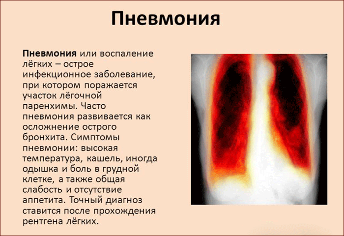 симптомы пневмонии