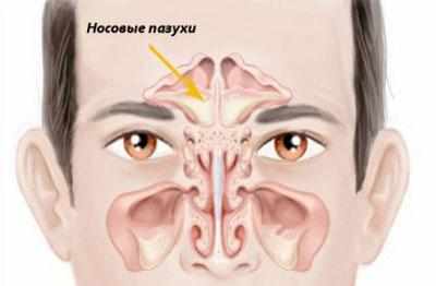 Носовые пазухи при синусите