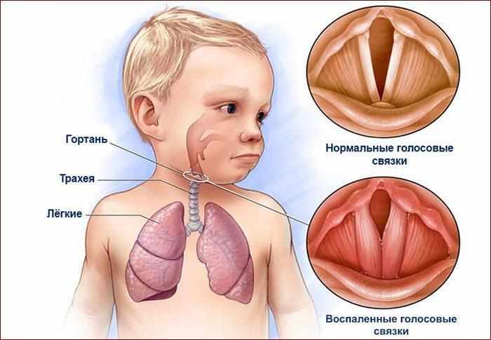 Отек голосовых связок ребенка
