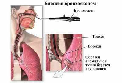 Биопсия бронхоскопом