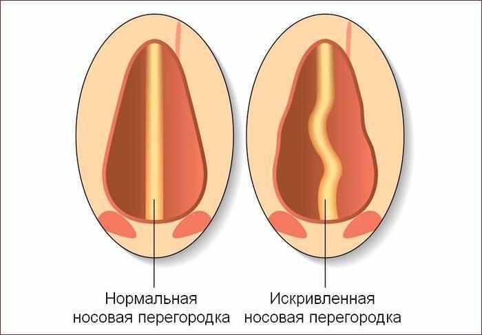 искривление перегородки носа