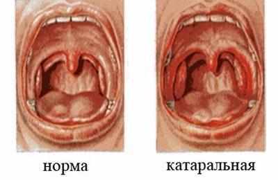 Катаральная ангина