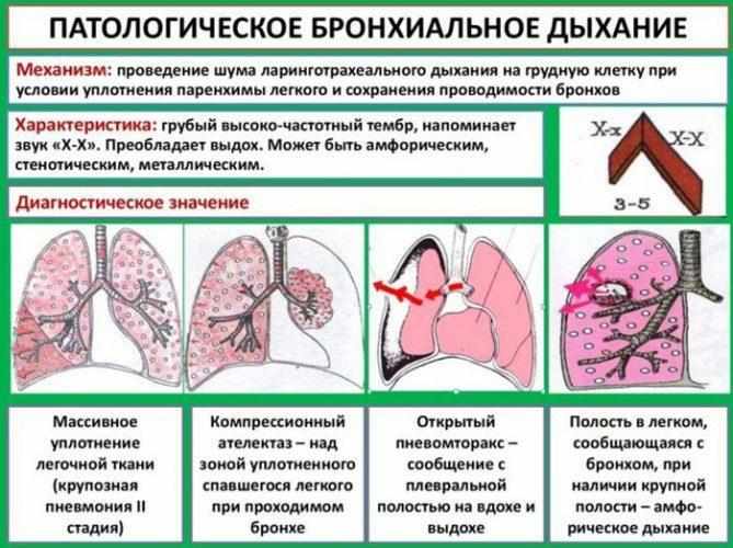 Диагностика по бронхиальному дыханию
