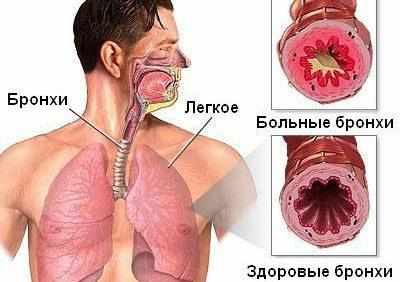 Симптомы бронхита