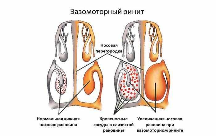 Вазомоторный ринит