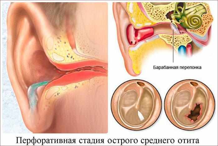 перфоративный отит