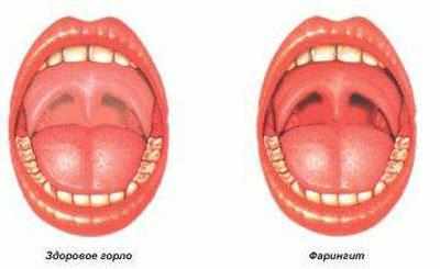 Горло при фарингите
