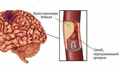 Ишемический инсульт
