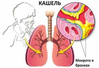 Возникновение кашля