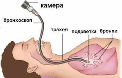 Проведение бронхоскопии