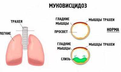 Проявление муковисцидоза