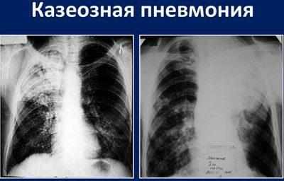 Казеозная пневмония