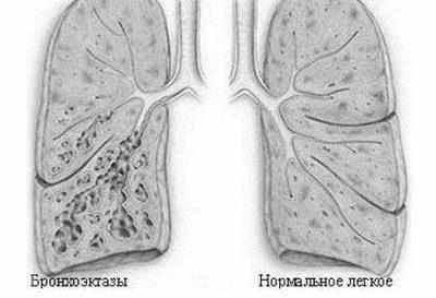 Бронхоэктаническая болезнь
