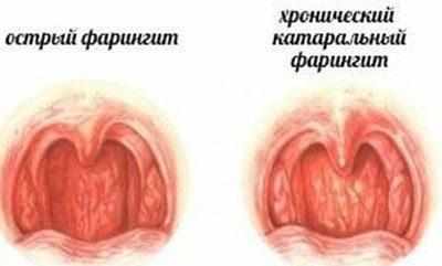 Виды фарингита