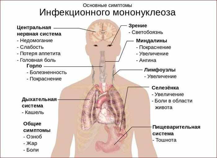 симптомы мононуклеоза