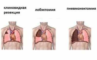 Операции на легком