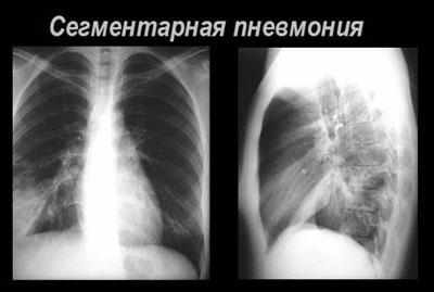 Сегментарная пневмония на рентгене