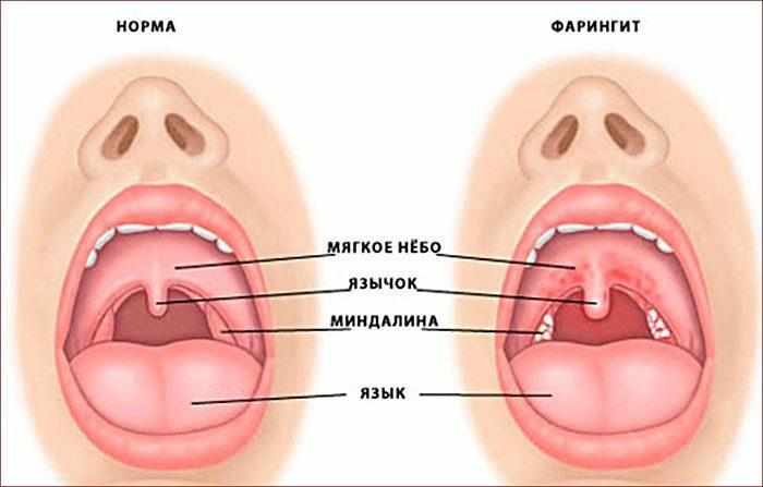 Горло при фарингите