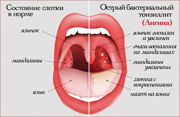 симптомы ангины