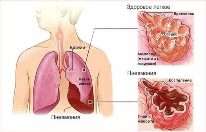 Проявление пневмонии