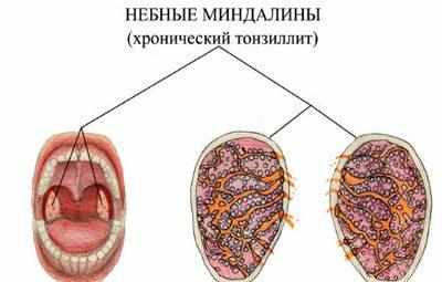 Проявление хронического тонзиллита