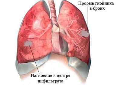 Абсцесс легкого