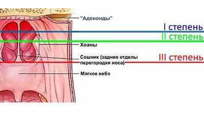 Степени аденоидов