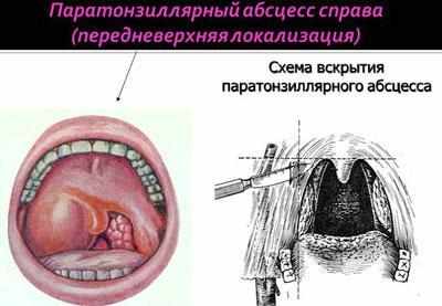 Локализация паратонзиллярного абсцессо