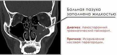 Гайморит на рентгеновском снимке