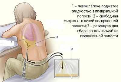 Откачивание жидкости из легких