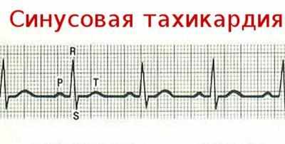 Кардиограмма при тахикардии