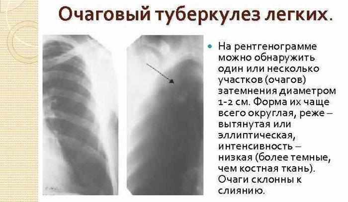 Очаговый туберкулёз лёгких