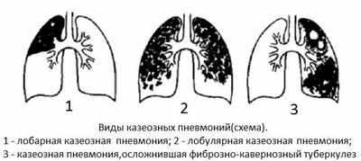Виды казеозной пневмонии