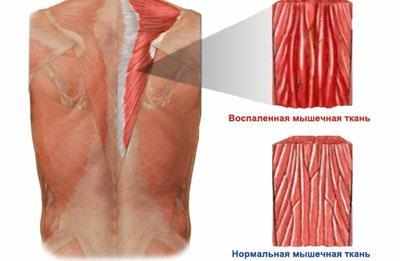 Воспаление при миалгии
